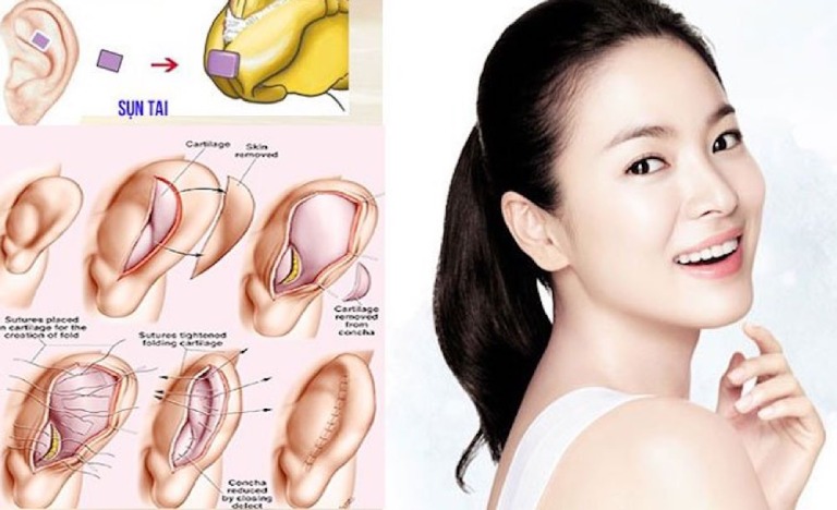 Nâng mũi sụn tai là gì