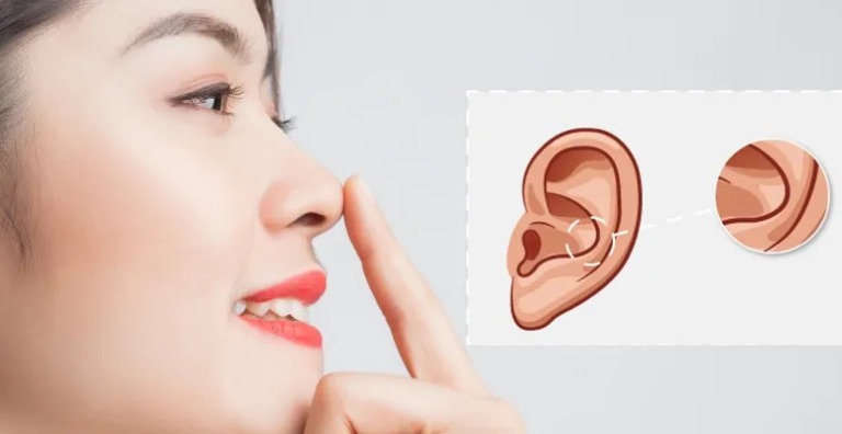 ưu điểm của nâng mũi sụn tai