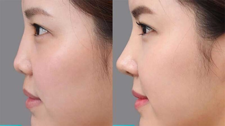 Đối tượng nên và không nên nâng mũi sụn tai