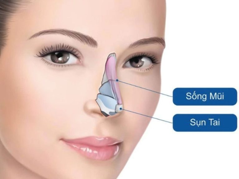 Nâng mũi sụn tai giá bao nhiêu