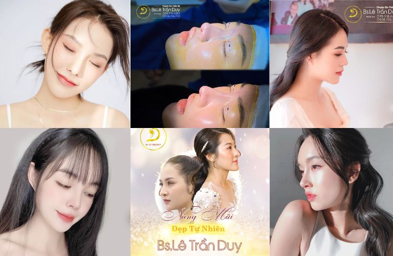 Nâng mũi tại Thẩm mỹ viện Galaxy - BS Lê Trần Duy