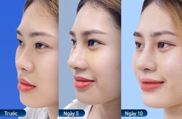 Nâng mũi tại Lâm Đồng