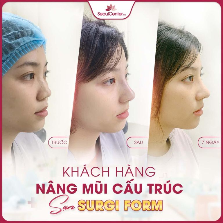 Nâng mũi cấu trúc tại Thẩm mỹ viện Seoul Center