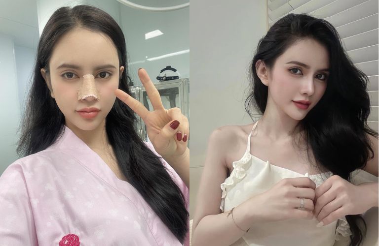5 Địa chỉ nâng mũi tại Quận 2 uy tín, giá tốt