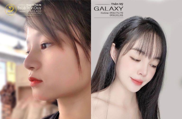 Tỉ lệ thành công 100% và phục hồi nhanh chóng