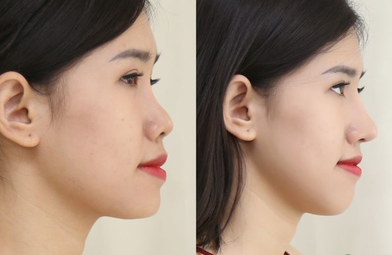 Địa chỉ nâng mũi tại Quận 4
