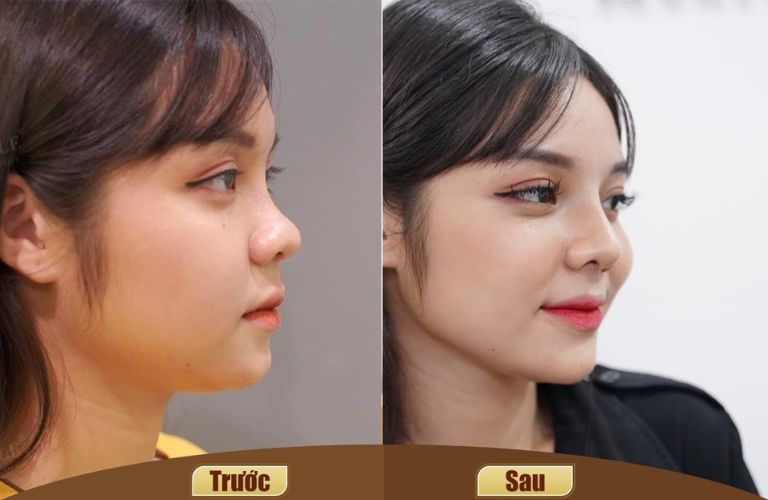 Cần nâng mũi ở những địa chỉ uy tín