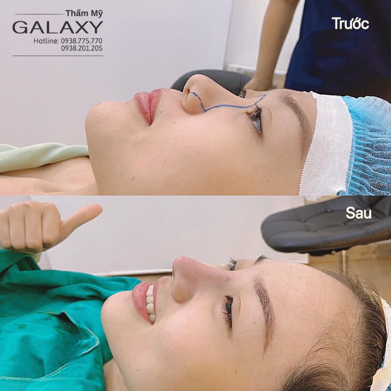 Thẩm Mỹ Viện Galaxy cung cấp quy trình thẩm mỹ mũi khoa họ
