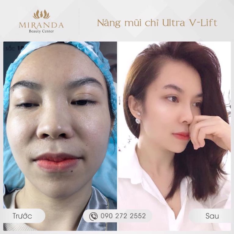 Nâng mũi bằng công nghệ hiện đại tại Miranda Beauty Center quận 8