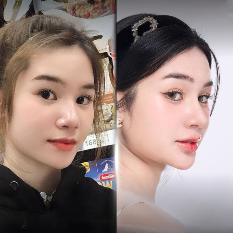 Chọn phương pháp nâng mũi phù hợp