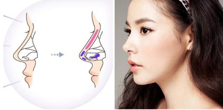 Nâng mũi vi chạm là gì