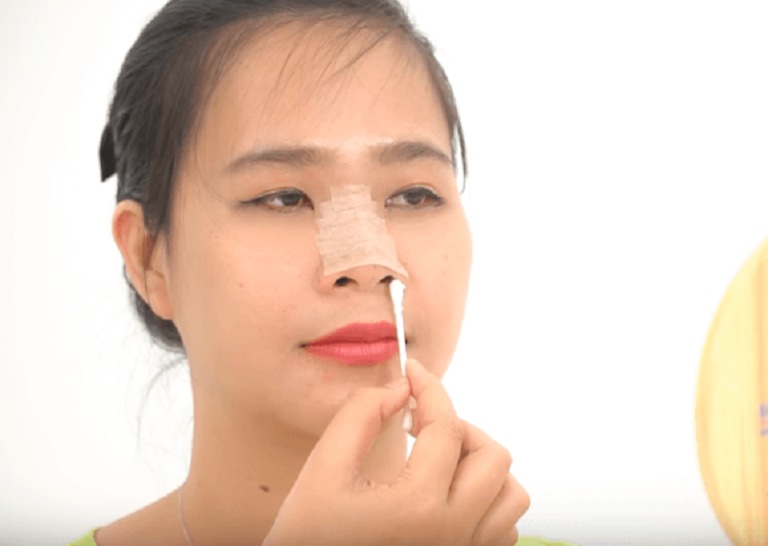 Cách chăm sóc hậu phẫu sau nâng mũi vi chạm