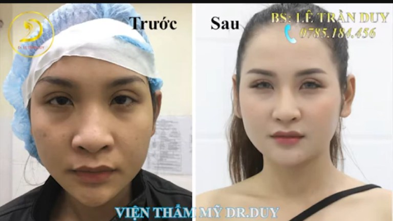 sau nâng mũi uống nước cam được không