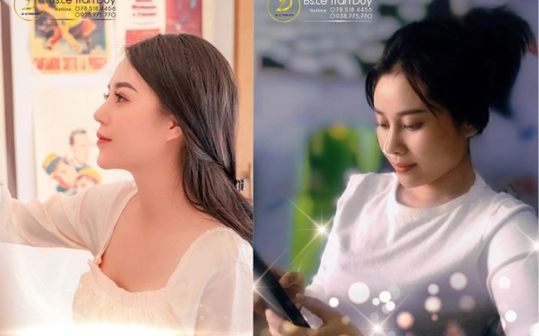 Nên nâng mũi cấu trúc hay bọc sụn