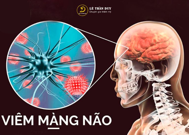 Rủi ro khi tiêm Filler - Gây viêm màng não