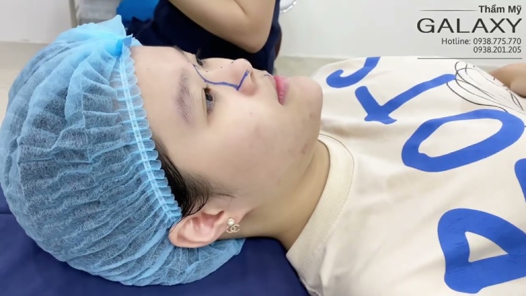 Nâng mũi cấu trúc tháo ra được không?