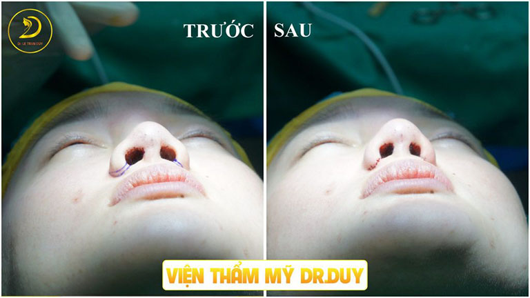 Thẩm mỹ Galaxy Bác sĩ Lê Trần Duy - Địa chỉ thu gọn cánh mũi uy tín tại TP HCM