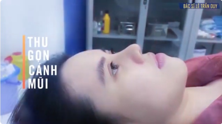 Thu gọn cánh mũi là gì