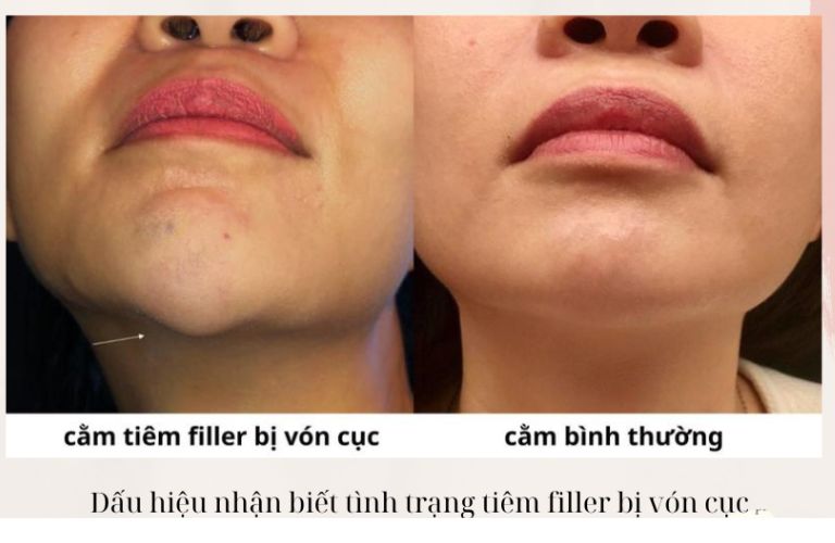 Hình dạng vùng tiêm bị biến dạng