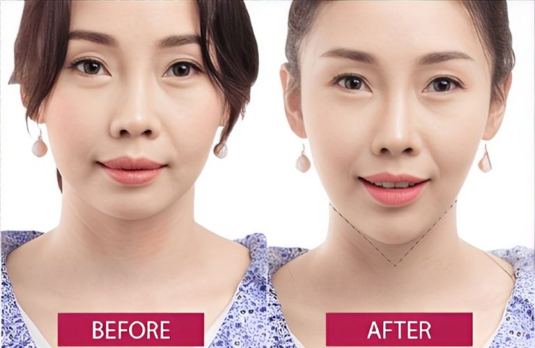 Tiêm Filler cằm có thể mang lại hiệu quả tức thì
