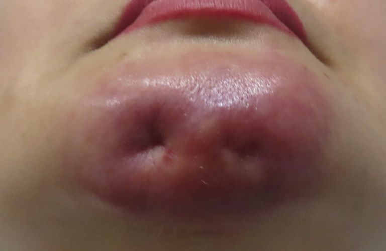 Bầm tím, sưng tấy kéo dài