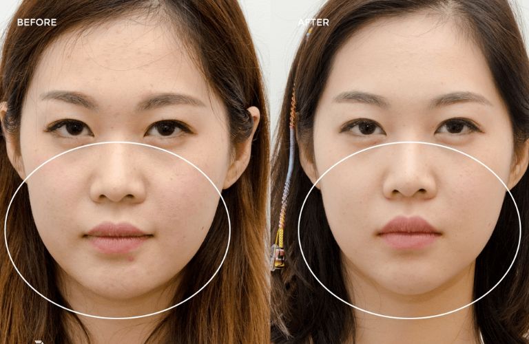 Hiệu quả làm đẹp bằng Filler phụ thuộc nhiều vào tay nghề bác sĩ