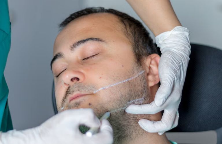 Nam giới hoàn toàn có thể tiêm Filler cằm