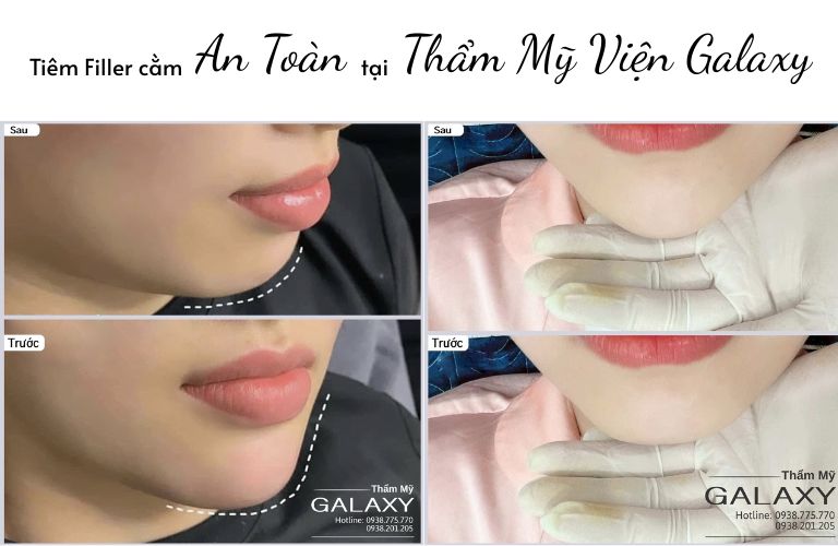 Tiêm Filler cằm tại Thẩm mỹ viện Galaxy – Bác sĩ Lê Trần Duy