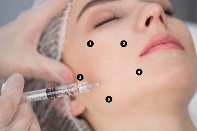 Kỹ thuật tiêm filler má