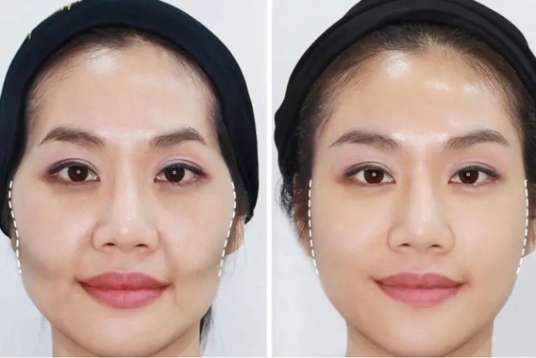 Lợi ích sau khi tiêm filler má