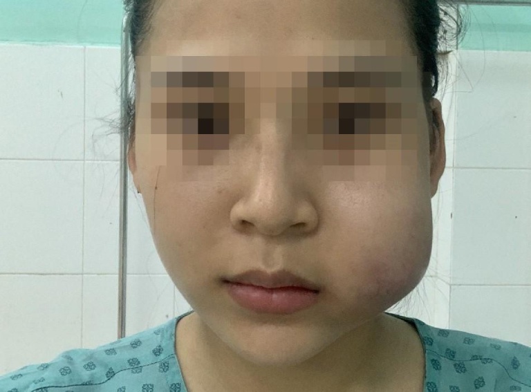 Tiêm filler má bị sưng