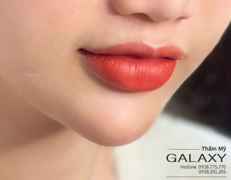 Tiêm Filler môi đẹp tự nhiên, không biến chứng tại Thẩm mỹ viện Galaxy