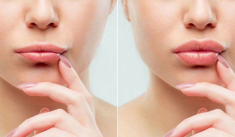Người có môi mỏng, thiếu cân đối