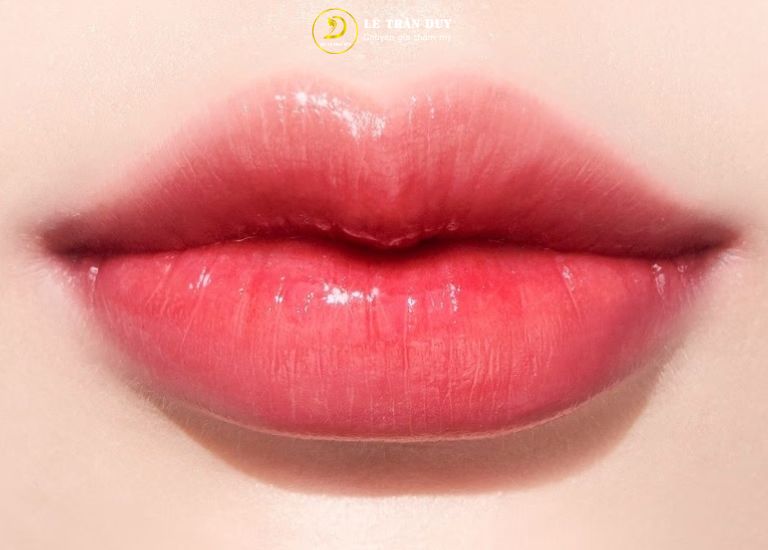Tiêm filler môi giữ được bao lâu?