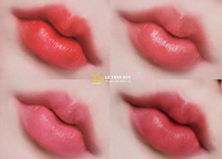 Có nhiều kiểu tiêm Filler môi đẹp, bền lâu
