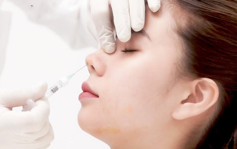 Ưu điểm của tiêm Filler mũi