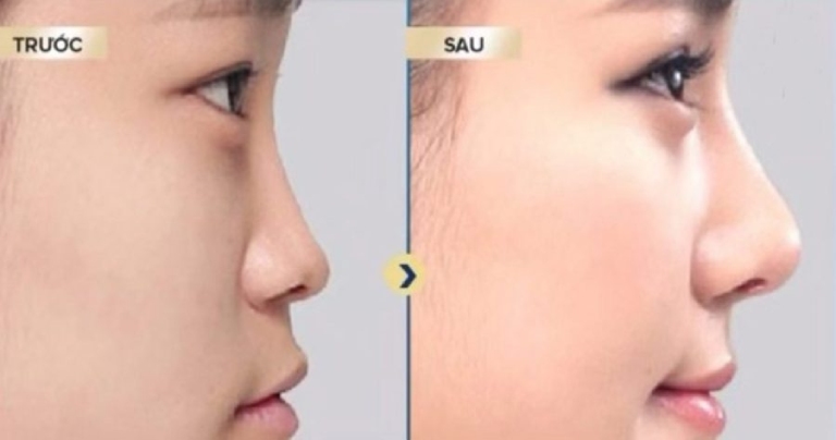Những ai nên tiêm filler mũi