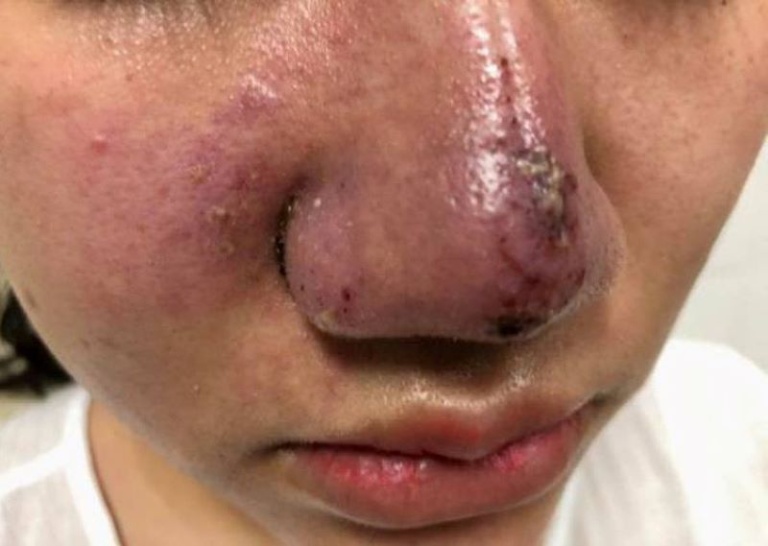 Tiêm Filler mũi có nguy hiểm không