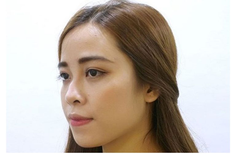 Dáng mũi bị biến dạng, không đều