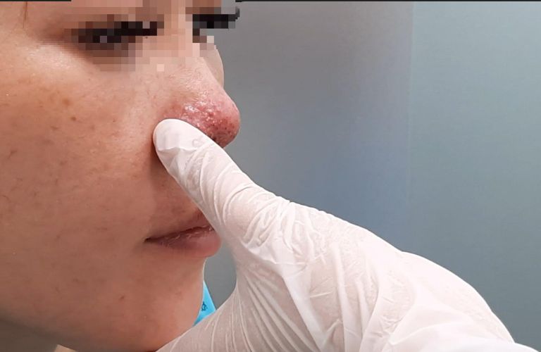 Vón cục, hoại tử mô mềm