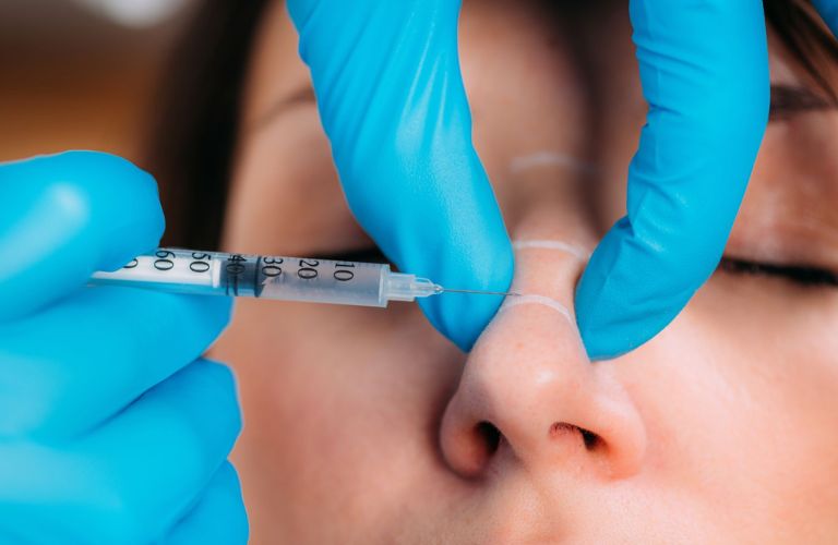 Tiêm Filler mũi bị tràn cần được thực hiện đúng kỹ thuật