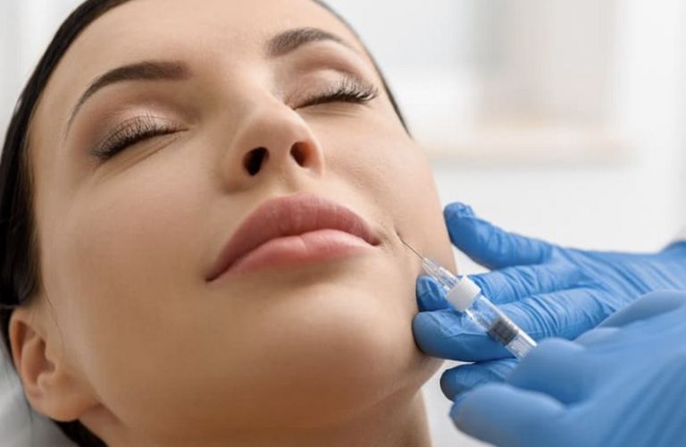 Tiêm Filler rãnh cười