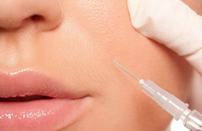 Chất filler thường dùng là Hyaluronic Acid, có độ an toàn cao, ít gây kích ứng hay đào thải