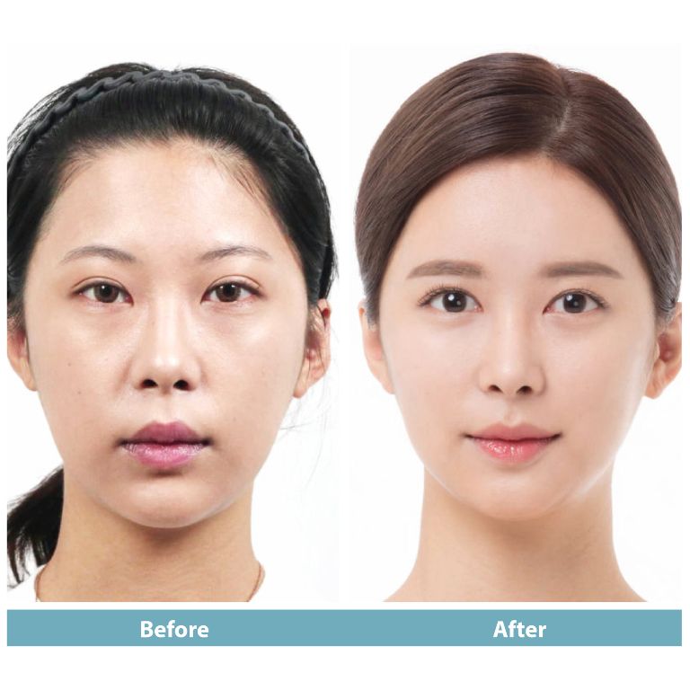 Hiệu quả thấy rõ ngay sau khi tiêm