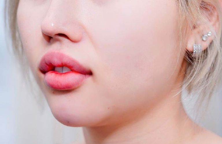 Tiêm Filler sau 1 năm bị sưng