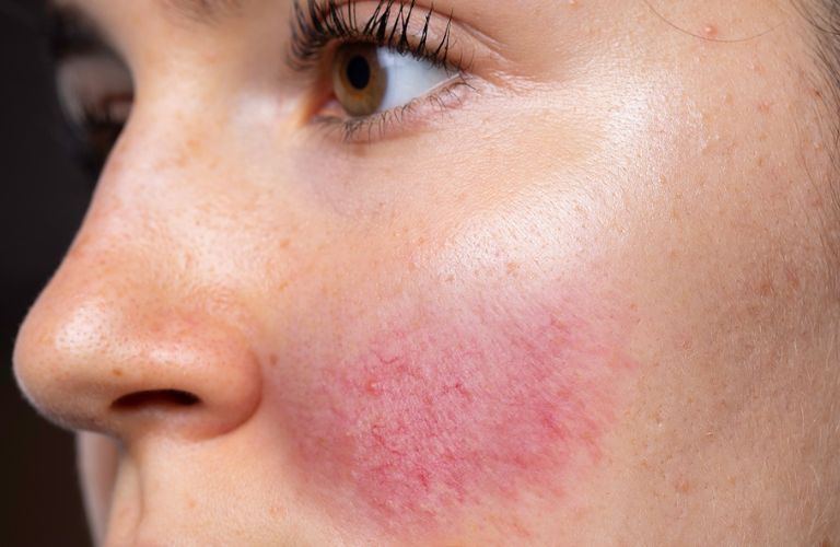 Dị ứng muộn hoặc phản ứng quá mẫn