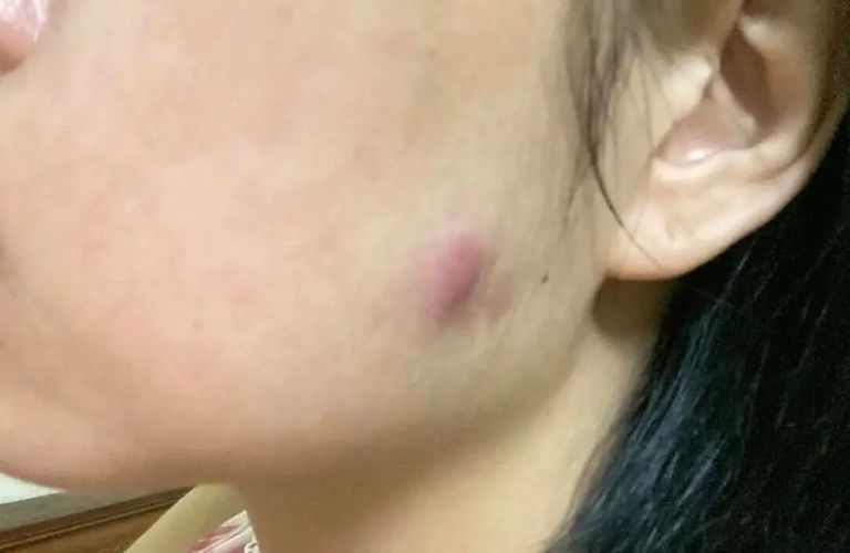 Phản ứng viêm khiến vị trí tiêm bị sưng từ nhẹ đến nặng kèm theo đỏ da