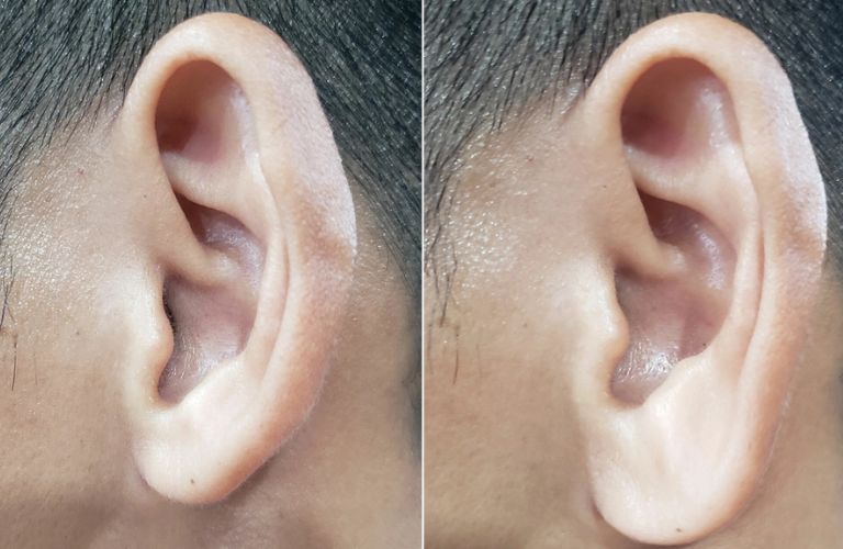 Tiêm Filler tai giúp cải thiện tướng số