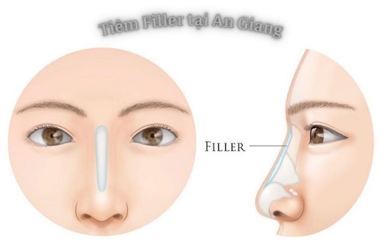Tiêm filler uy tín tại An Giang