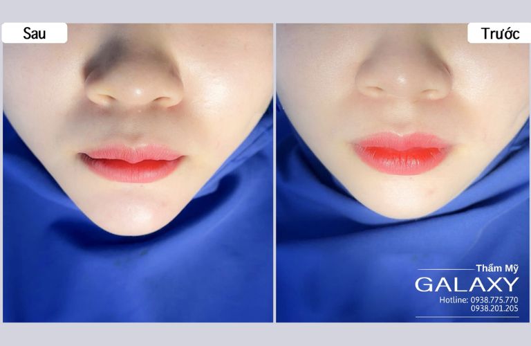 Kỹ thuật tiêm filler chuẩn y khoa